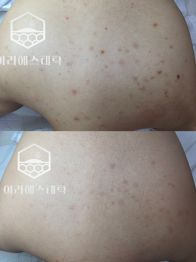 (광주여드름전문)등드름 몇 번 받아야 좋아질까?