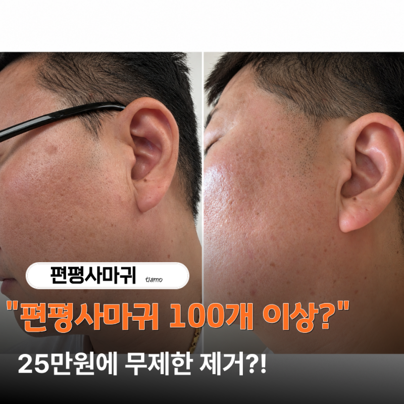 부산 편평사마귀 무제한 제거 성지 25만원 타임이벤트 내돈내산 후기