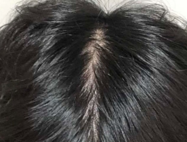 바르는 탈모치료제 마이녹실 3% 5% 효과 부작용 사용법