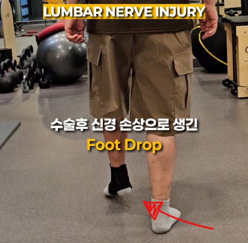 [먹골 PT & Plates] 수술 후 신경 손상으로 생긴 풋드랍, 발목이 움직이지 않아도 보행은 달라질 ....