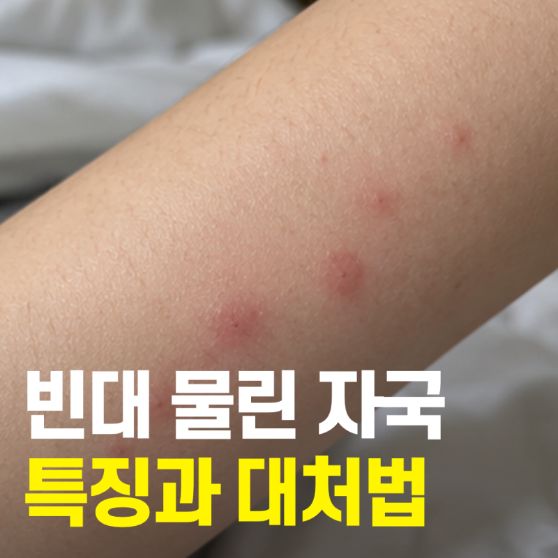빈대 물린자국 특징, 모기와 차이부터 대처법까지