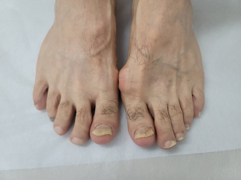 천안 발관리, 발톱이 두꺼워지고 색이 변했다면? 무좀 의심 증상부터 관리까지