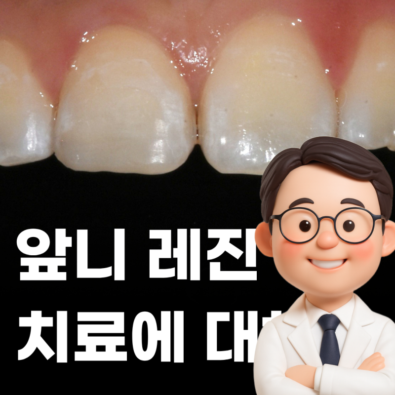 앞니 레진 치료에 대해서