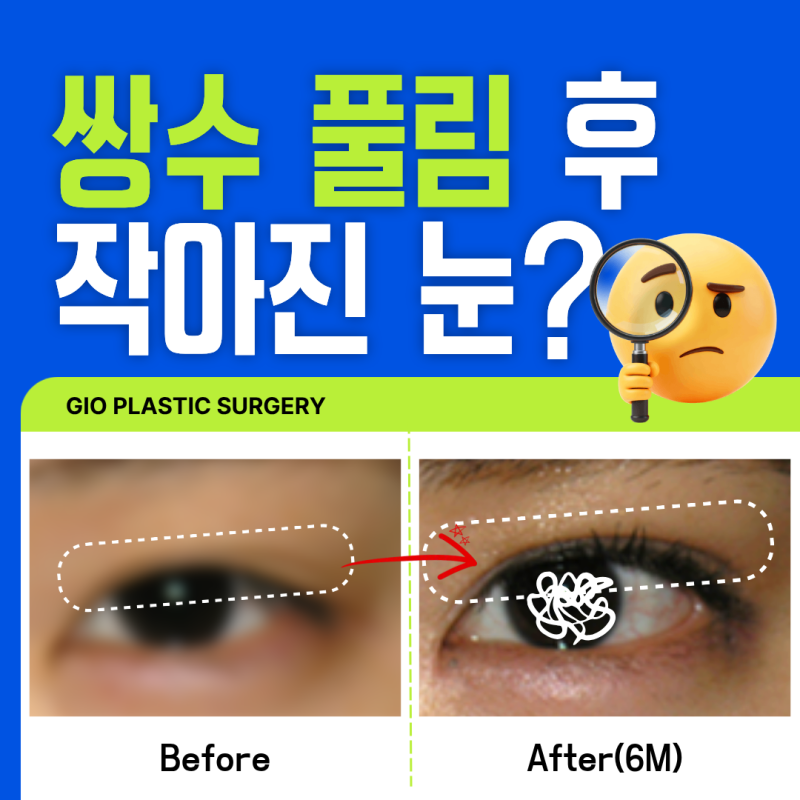 쌍꺼풀 풀림 재수술 비용 크지 않을거란 기대