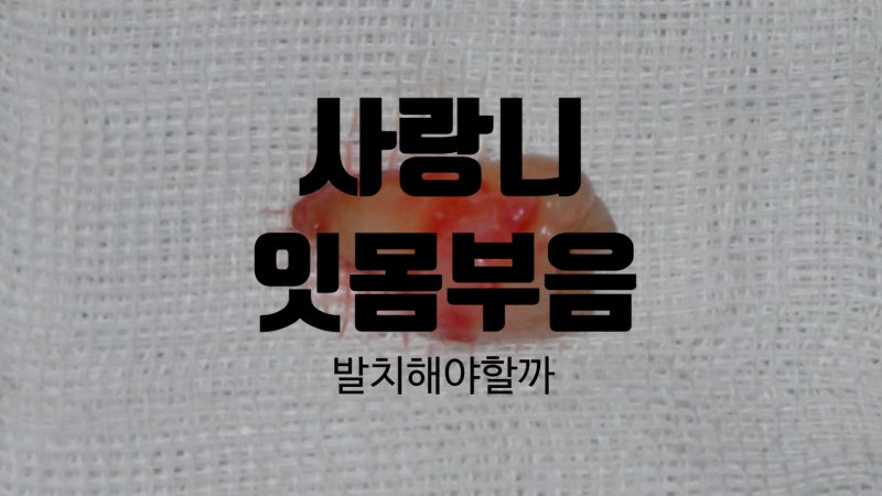 사랑니 잇몸 부음, 발치해야 할까? 서울시청치과