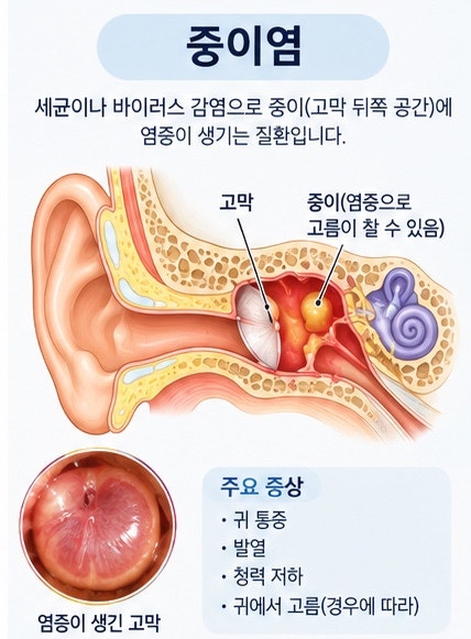 중이염이란?｜귀가 아프고 먹먹한 이유
