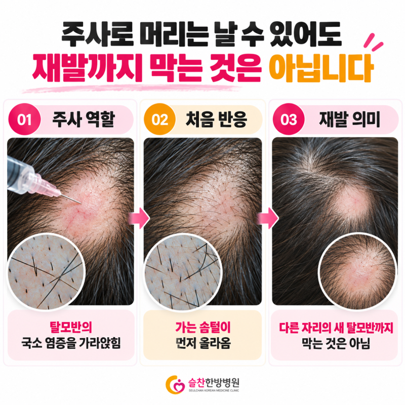 원형탈모 스테로이드 주사 부작용? 계속 재발한다면 3가지 확인해보세요