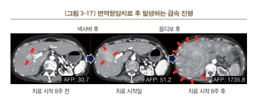 [간암 치료의 이해] 간암의 면역항암치료 (3)