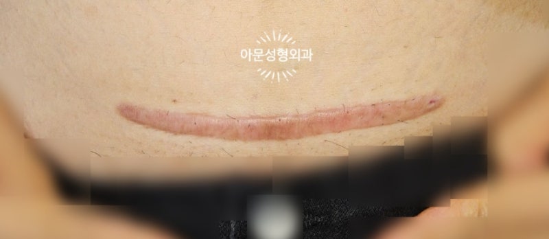 제왕절개 켈로이드 치료시 가장 효과적인 방법은? (서울 강동구 아문성형외과) 주사 방사선 ....