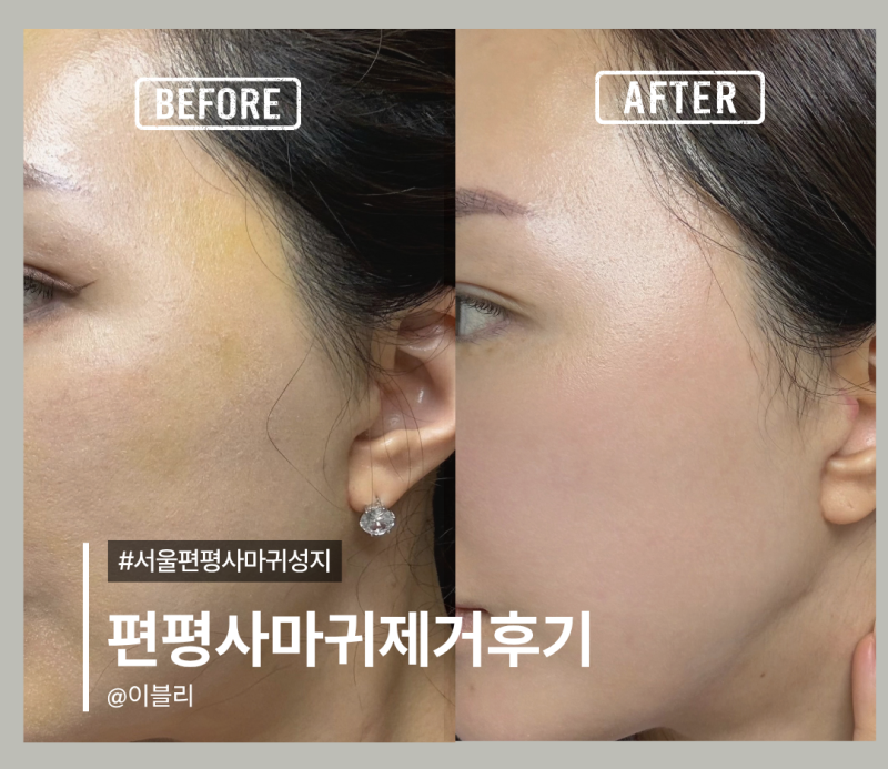 서울편평사마귀성지 무제한 제거 내돈내산 편사제거후 관리 듀오덤없는 솔직후기