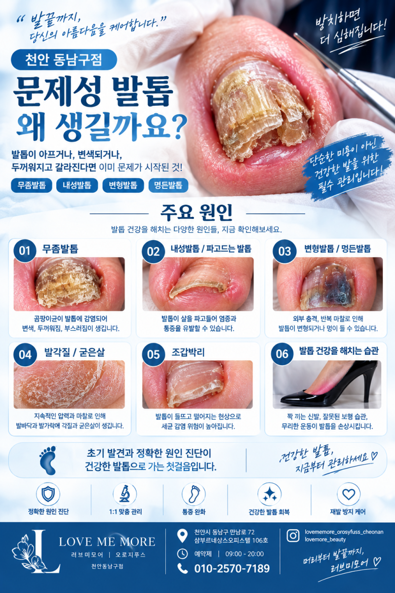 발톱이 노랗고 두꺼워졌다면 무조건 무좀일까? 문제성 발톱이 생기는 진짜 이유 - 러브미모....