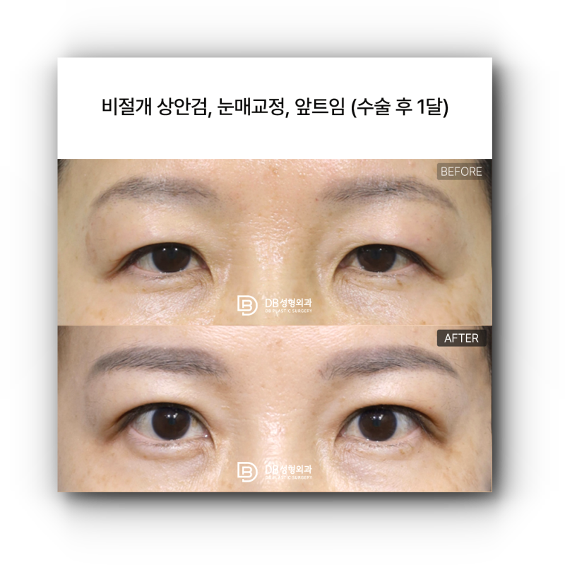 눈처짐수술비용, 사람마다 다른 이유는?