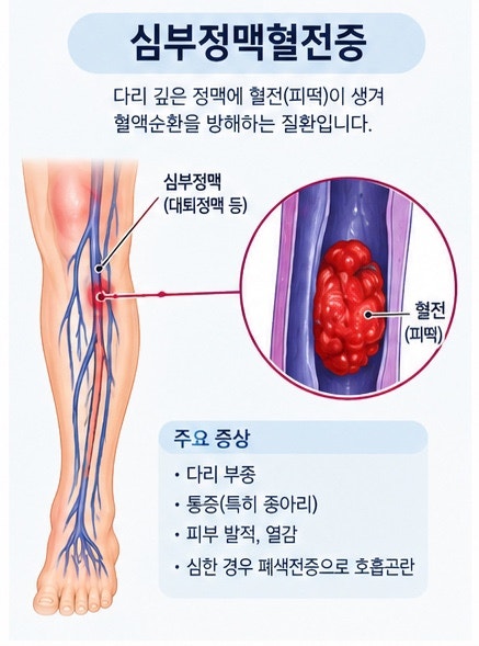 심부정맥혈전증이란?｜한쪽 다리만 붓고 아프다면