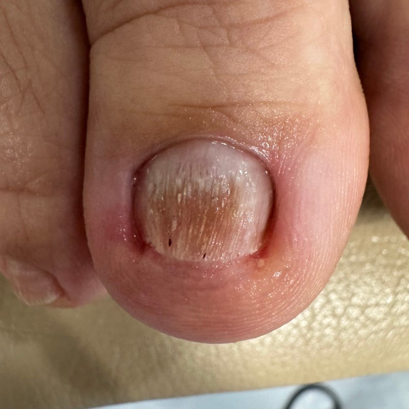 목동 내성 발톱무좀 병원에서 뛰어난 효과 케어 받았어요