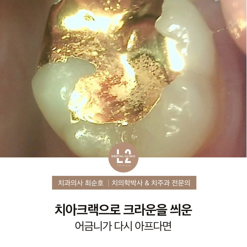 치아크랙으로 크라운을 씌운 어금니가 다시 아프다면