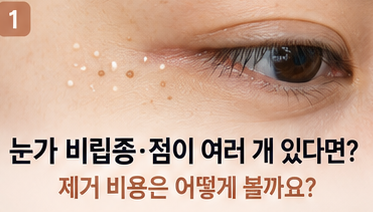 눈가 비립종·점이 여러 개 같이 있다면? 제거 비용과 무제한 기준
