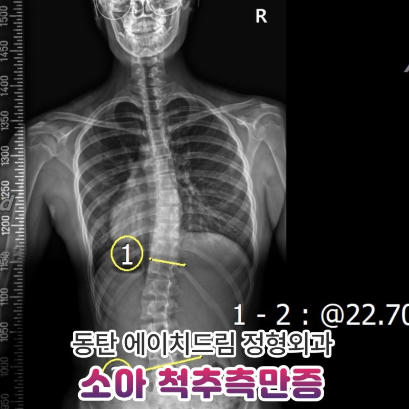 소아 척추측만증 10도·20도, 각도에 따라 무엇이 달라질까?