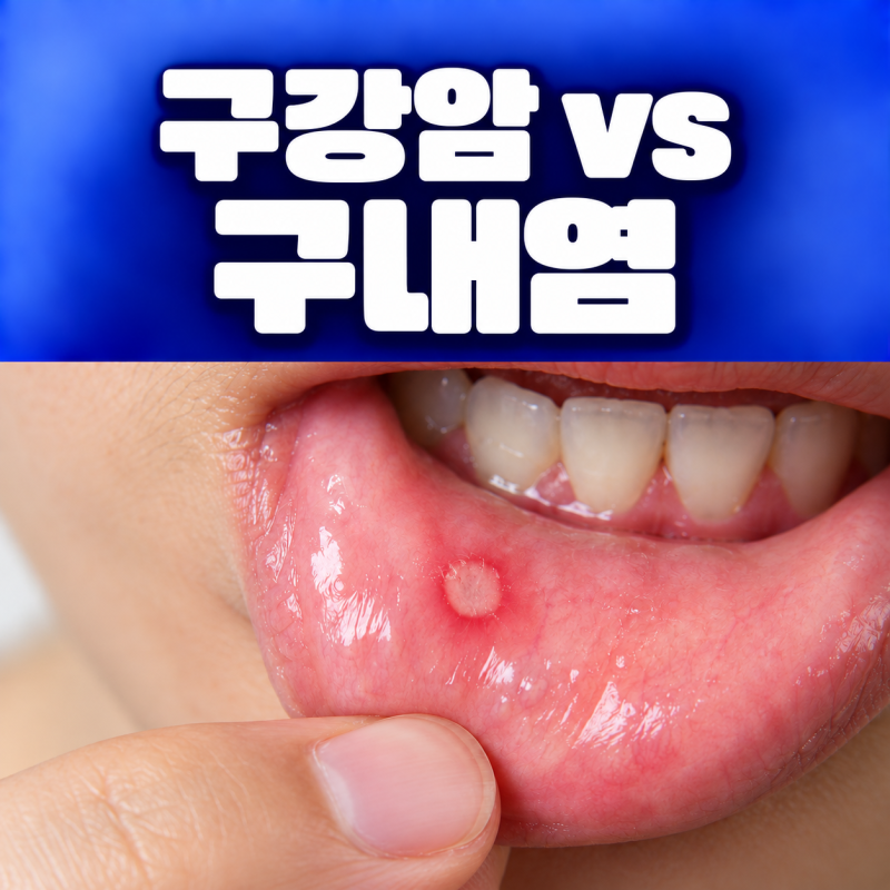 입술 구내염이 2주째 안 낫는다면 구강암?