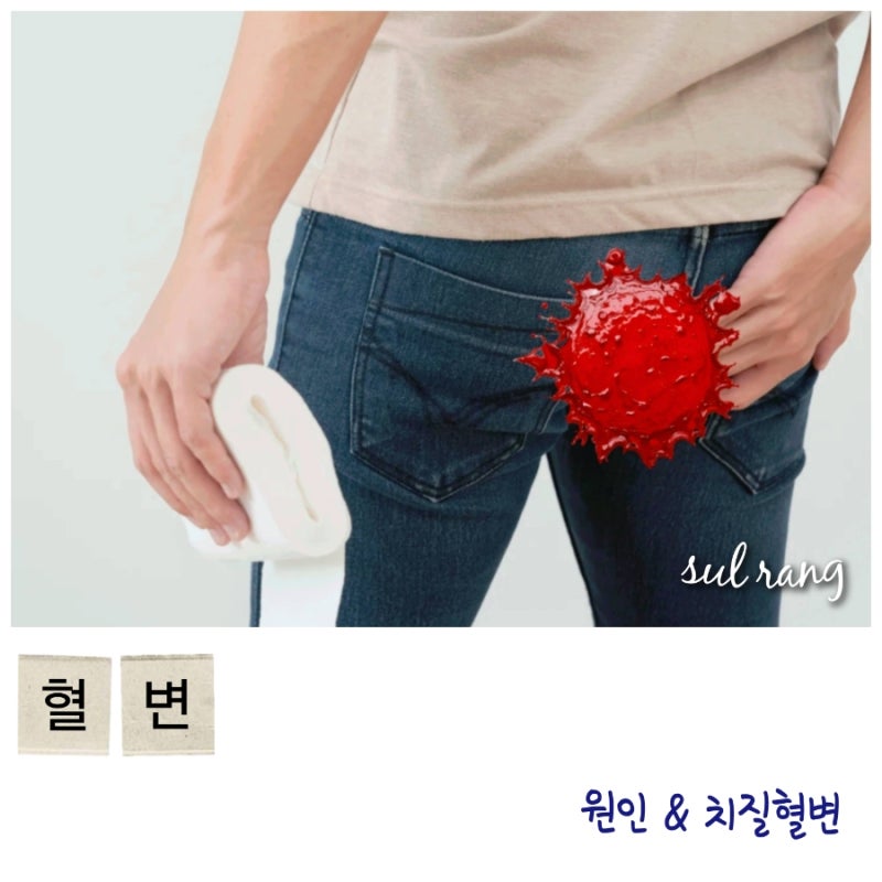 혈변 원인과 치질혈변 구별 어떻게?
