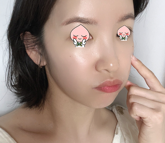 편평사마귀 co2레이저로 제거한뒤 2개월차 후기 (듀오덤, 재생크림)