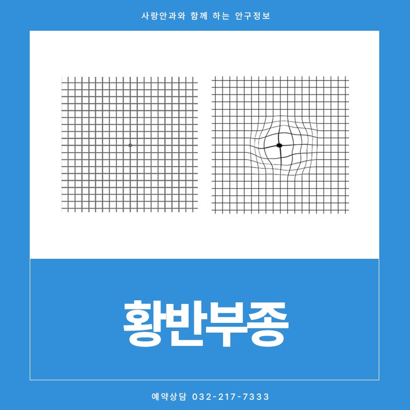 황반부종 치료 루센비에스주사는 언제 고려할까요?