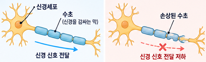 길랭-바레 증후군이란?