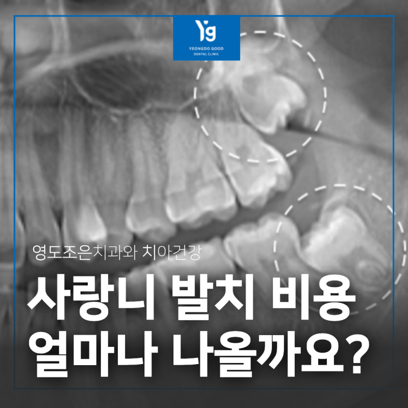 사랑니 발치 비용, 2026년 기준 얼마나 나올까요?