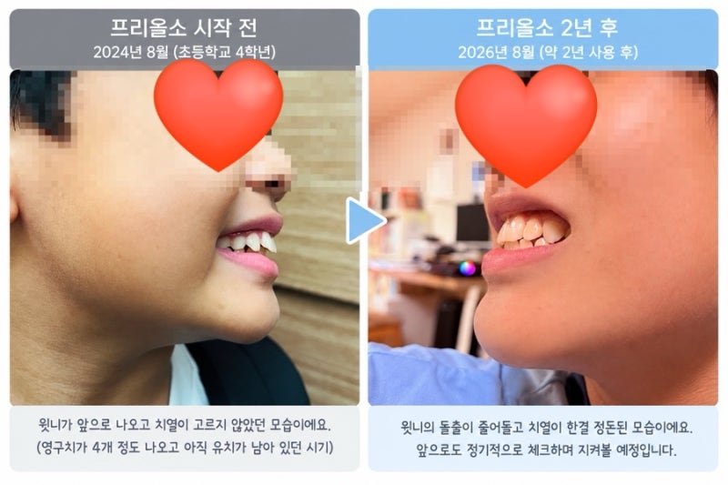 초4부터 시작한 프리올소, 2년 사용 후기｜어린이 부정교합 내돈내산 후기