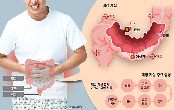 맹장염인 줄 알았는데 '대장 게실염'? 오른쪽 아랫배 통증 원인부터 좋은 음식까지 총정리