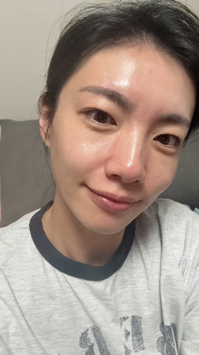 땅콩형 얼굴 탄력 모공 고민 청담피부과 고우리 스킨부스터 후기 (통증, 다운타임, 변화)