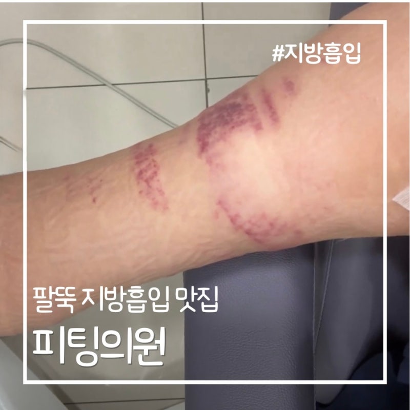 [지방흡입 후기] 강남 피팅의원 팔뚝 지방흡입 내돈내산 상담 후기, 수술 후기,,, 강추,,, b