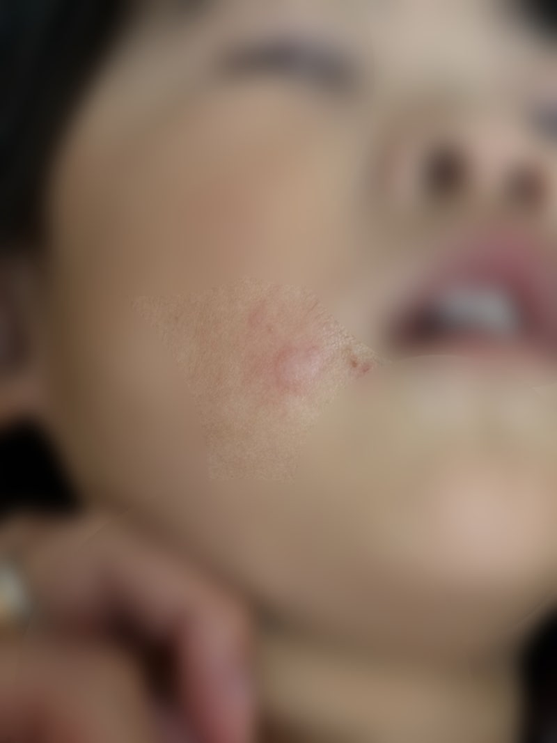 모기 자국처럼 올라왔다 10분 만에 사라지는 4살 아기 두드러기, 콜린성 두드러기 극복 가능....