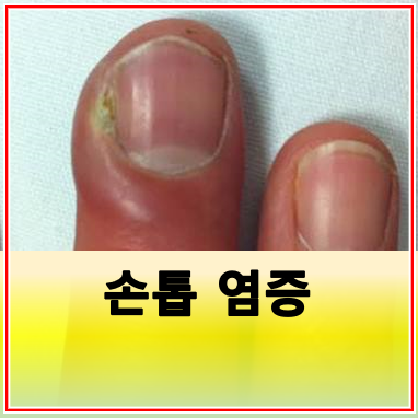 조갑주위염 손톱 염증 원인 증상 치료약