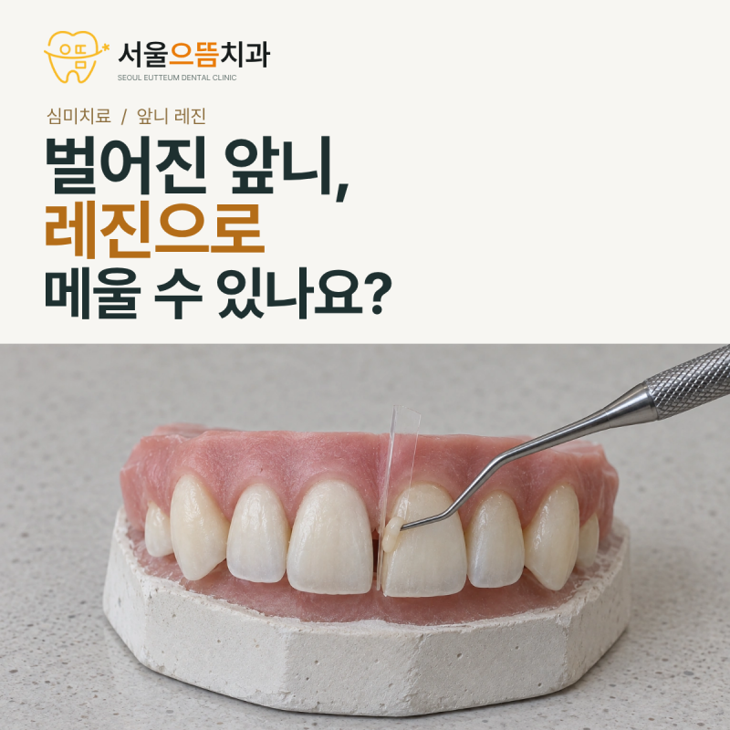 앞니 벌어짐, 레진으로 메울 수 있나요? 치료 과정과 관리법