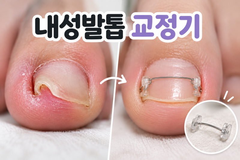 내성발톱 교정기 후기｜2N년째 고생 중인 내성발톱, 일주일 사용해봄