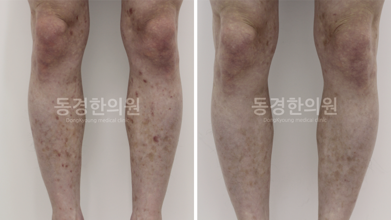 성인 자반증 치료, 나에게 맞는 병원 찾는 방법