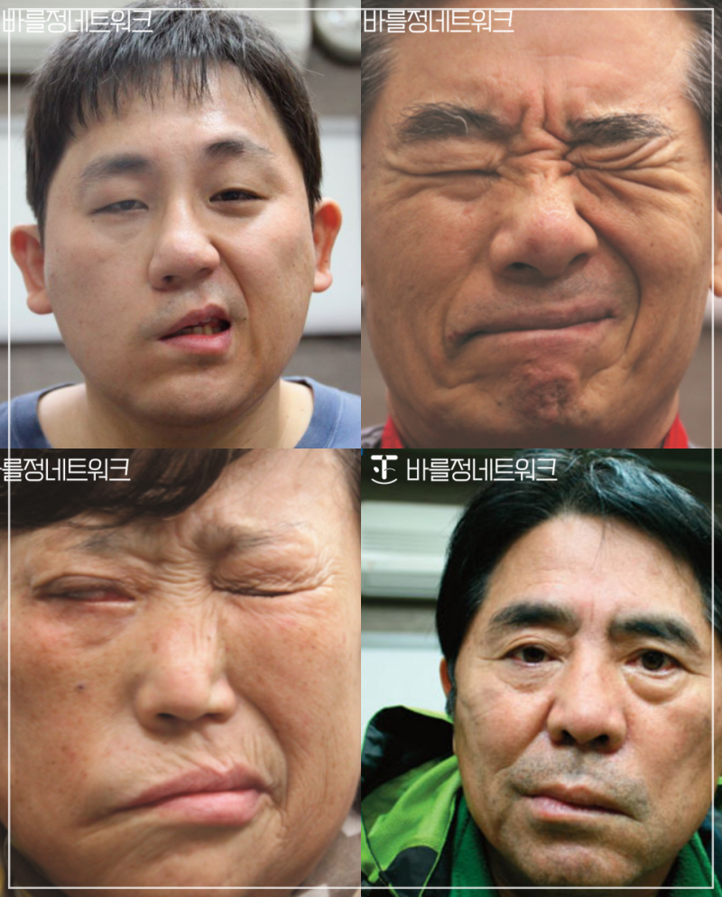 안면마비 초기증상, 귀 뒤가 찌릿하고 맛이 이상하다면?