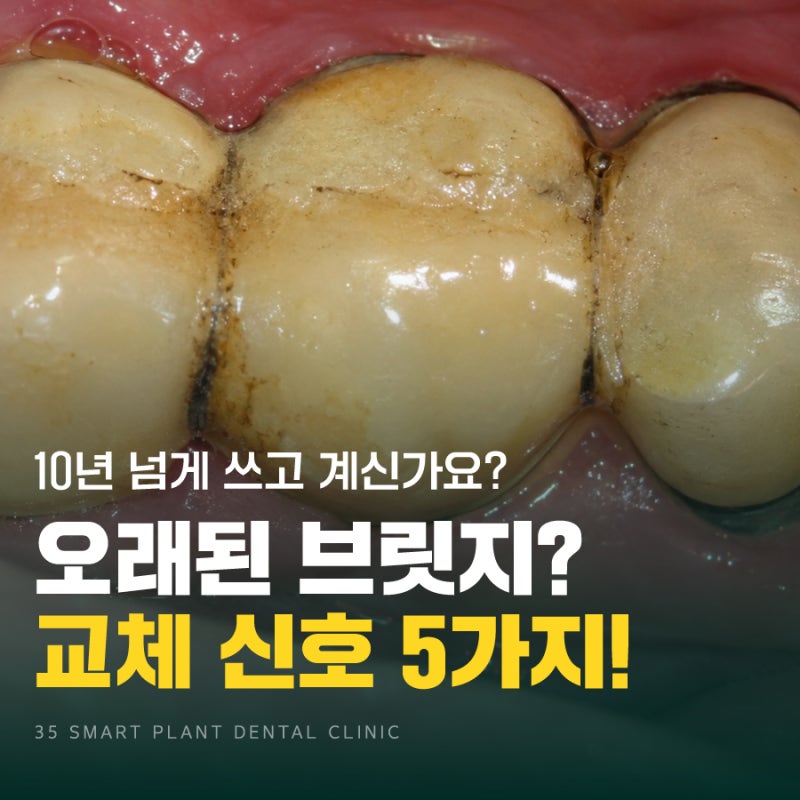 10년 넘은 브릿지, 언제까지 쓸 수 있을까? 교체 시기를 알리는 신호