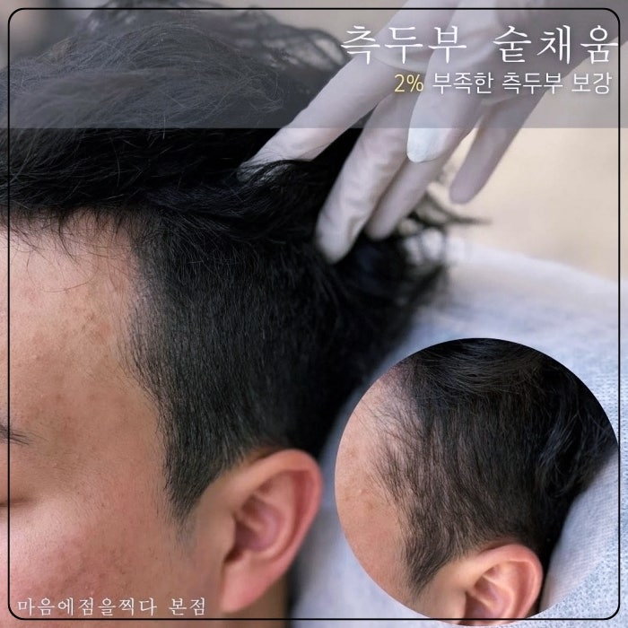 상무지구남자탈모, 정수리와 M자는 다르게 봐야 합니다