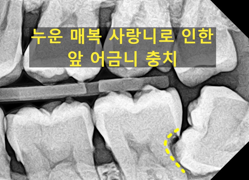 안산보존치과 사랑니 옆 어금니 깊은 충치, 발치 신경치료 대신 레진으로 치아 살리기