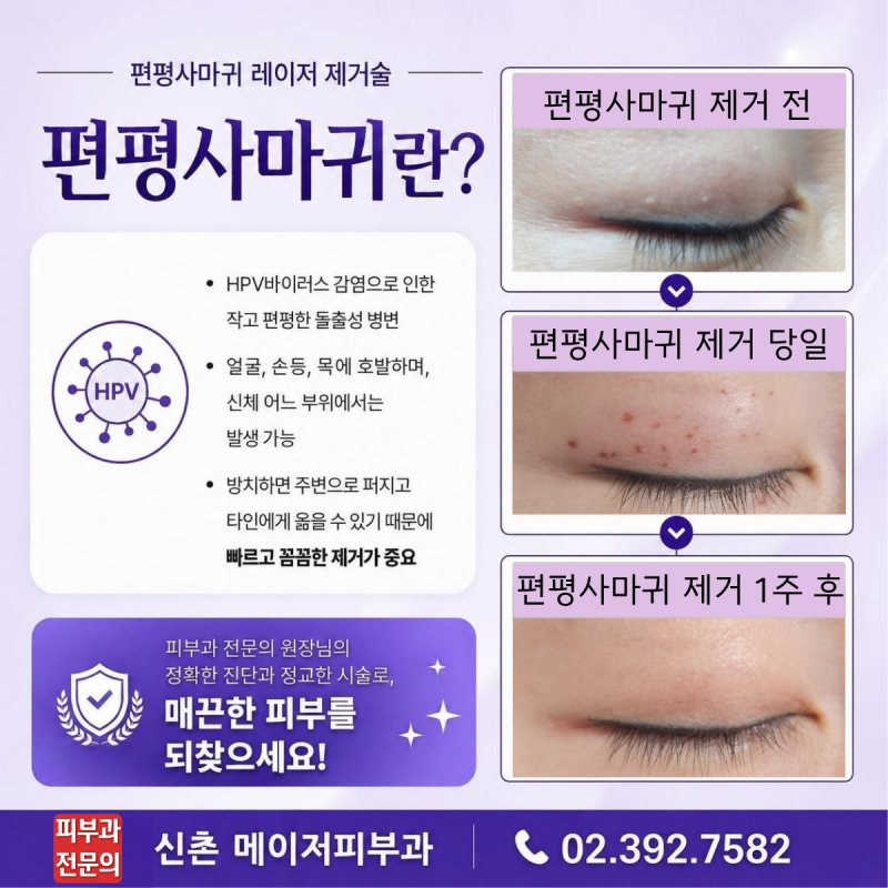 신촌 편평사마귀 제거 치료 레이저 피부과전문의 [신촌 메이저피부과]