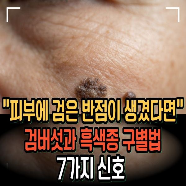 "피부에 검은 반점이 생겼다면" 검버섯과 흑색종 구별법 7가지 신호