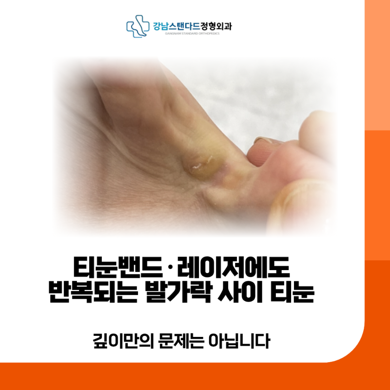 강남스탠다드정형외과 티눈밴드·레이저에도 반복되는 발가락 사이 티눈, 깊이만의 문제는 ....