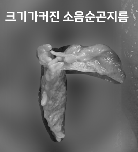 질 내부로 침투하는 여자 곤지름 증상, 원인, 치료 예후