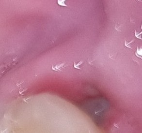 힘겨웠던 사랑니 발치 과정과 관리 방법
