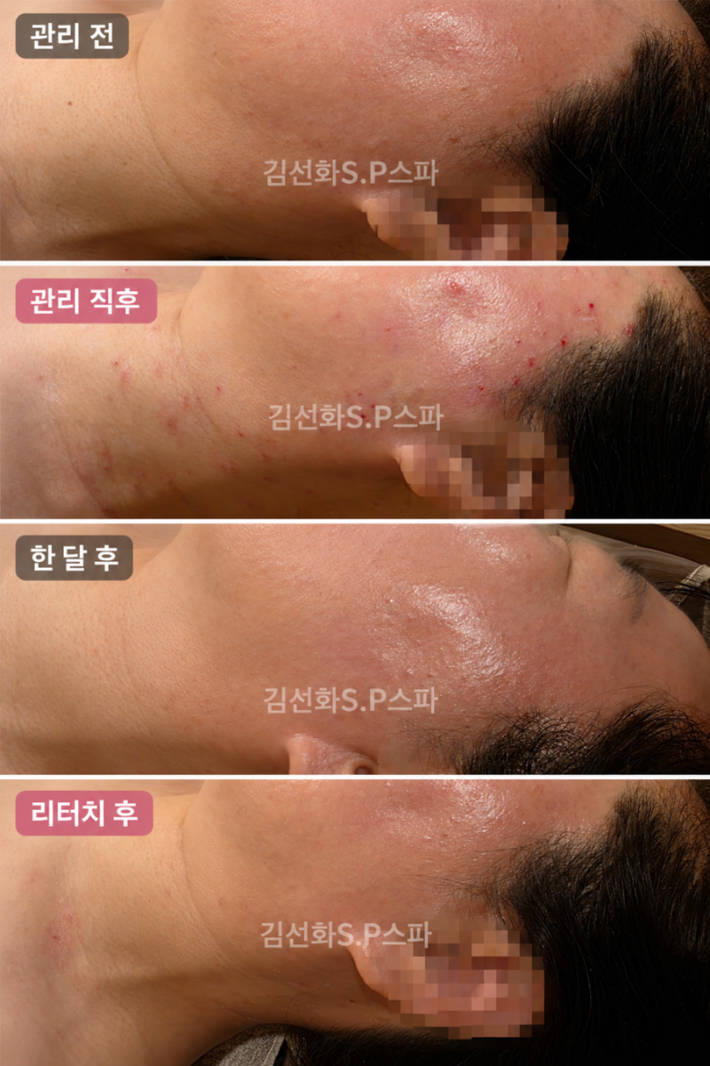 세종 실면도 얼굴 편평사마귀 목 쥐젖 관리 한 달 후 변화