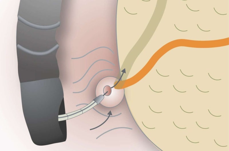 담낭질환 치료, 왜 ERCP 협진 시스템이 중요할까? 통합 진단부터 원스톱 치료까지 Q&A