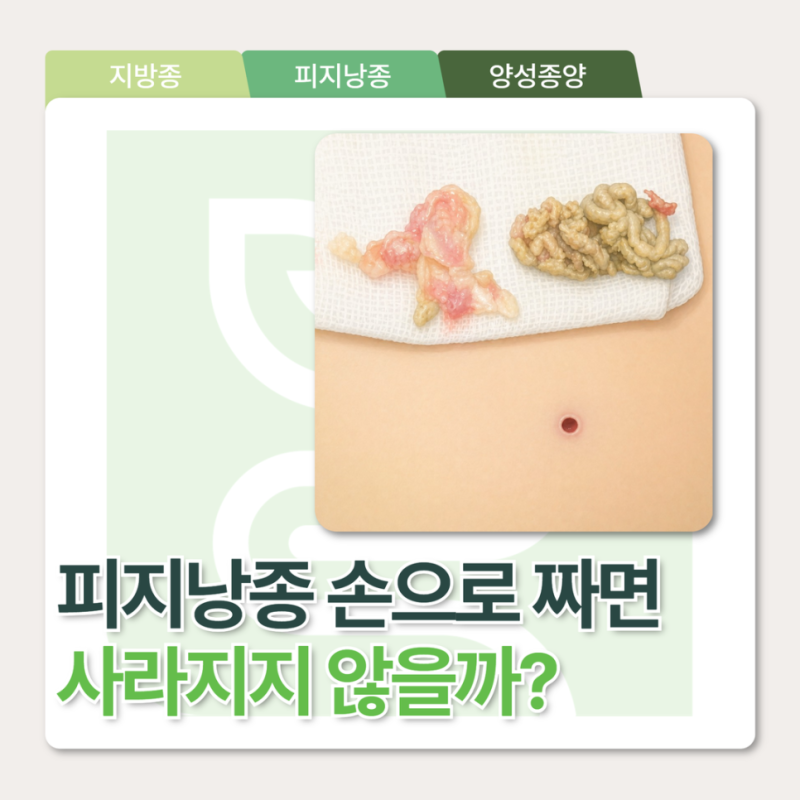 천안피지낭종 손으로 짜면 제거될까?