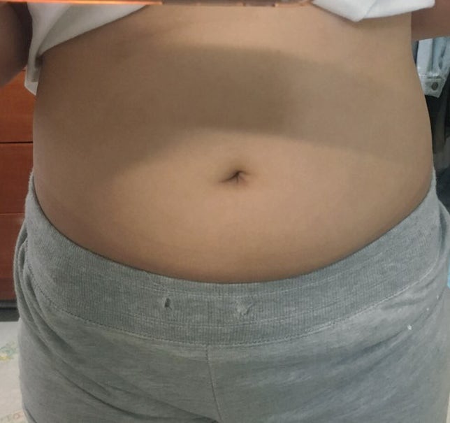 아이유 주사 후기, 3회 맞고 나서 뱃살 달라진 정도 솔직 후기