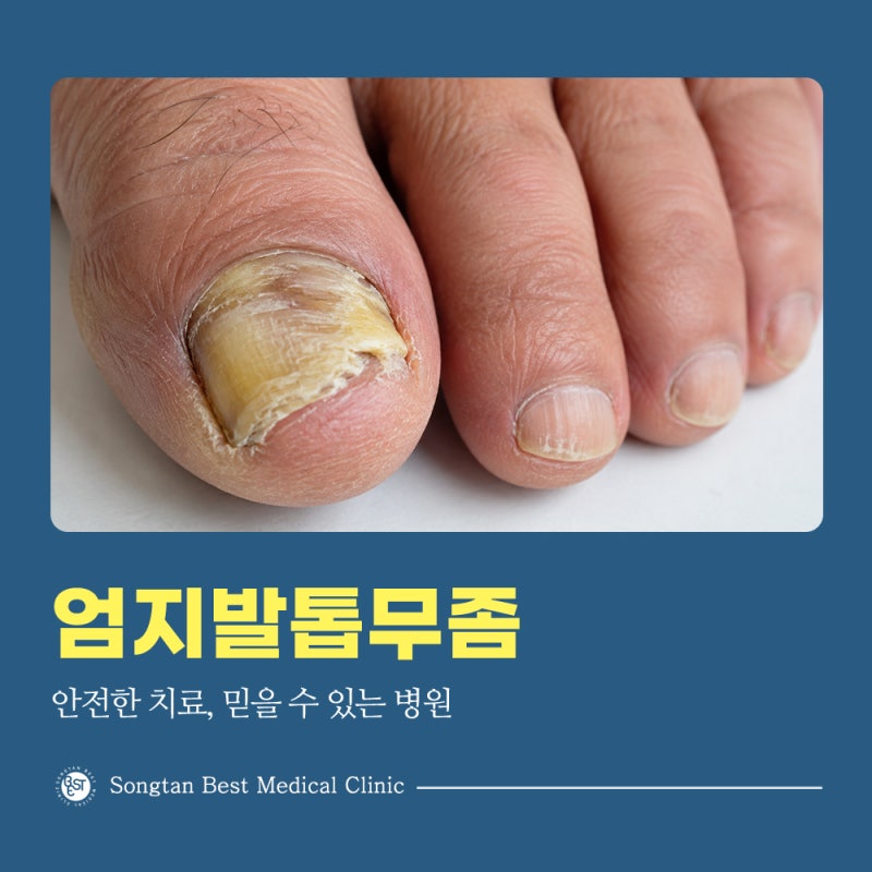 평택 엄지발톱무좀 두꺼워지고 갈라진다면 확인해볼 점